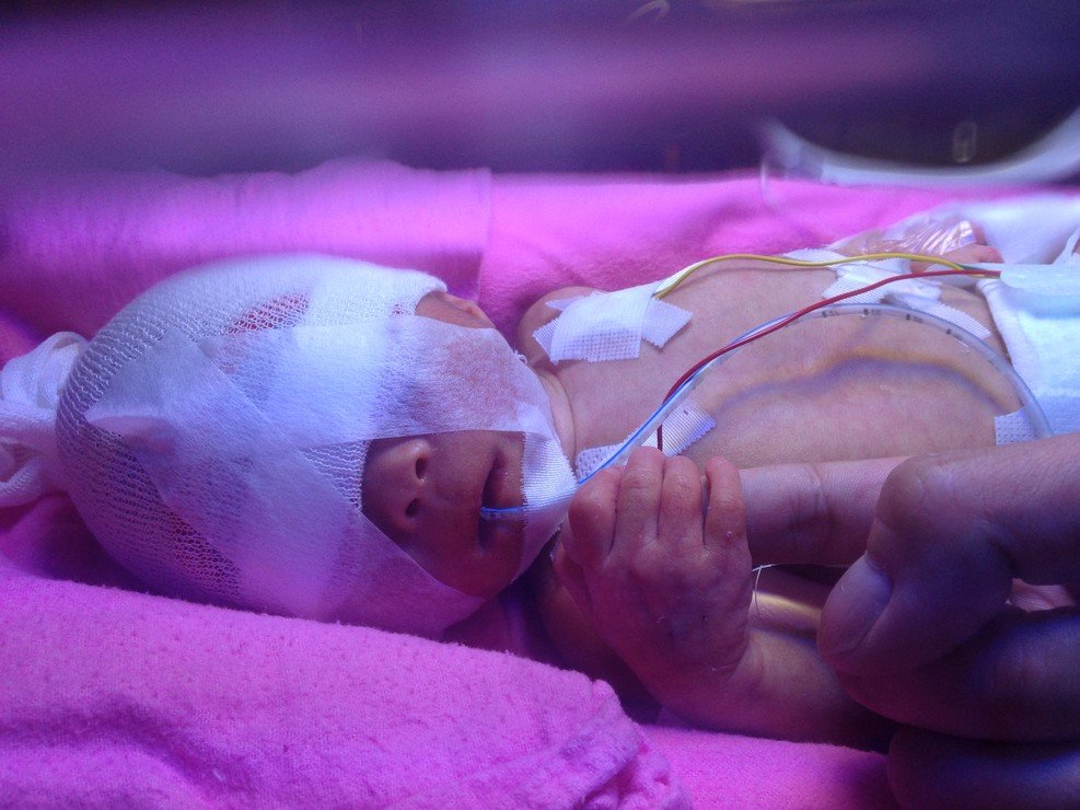 出生才幾天的希希，在嬰兒加護病房接受觀察及治療。(圖片由受訪者提供)